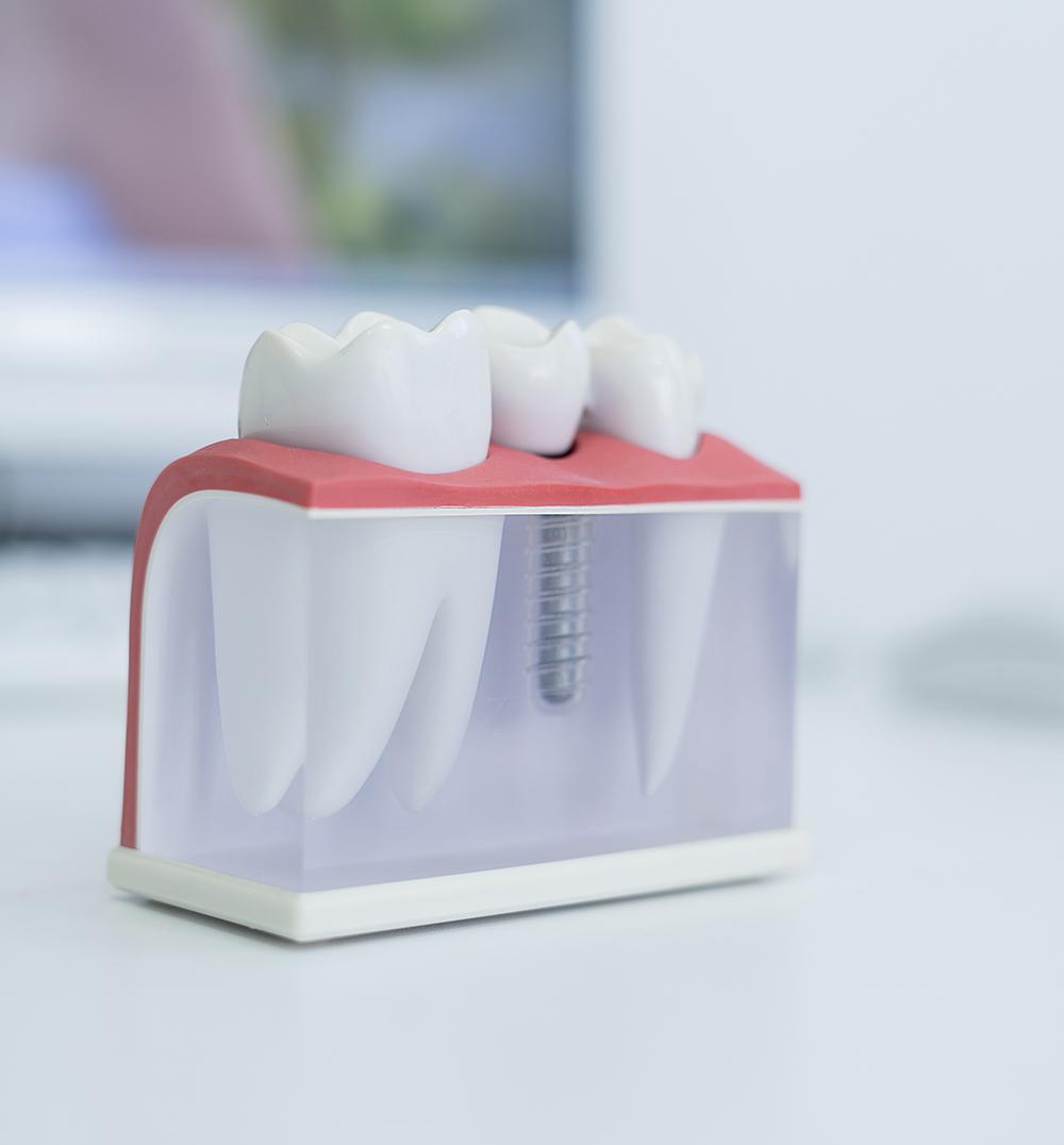 Procedimento de reabilitação com implantes dentários na clínica Aline Guzzi