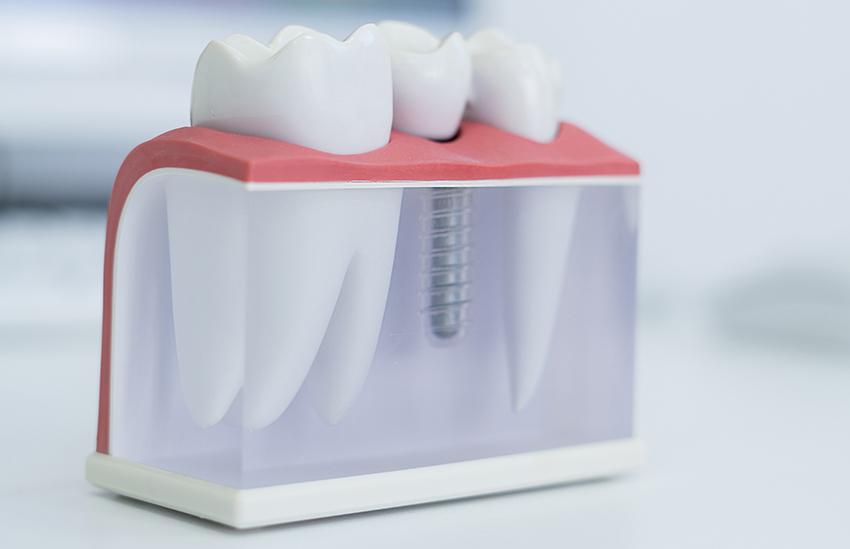 Procedimento de reabilitação com implantes dentários na clínica Aline Guzzi