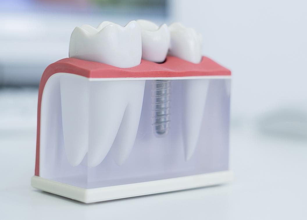 Procedimento de reabilitação com implantes dentários na clínica Aline Guzzi